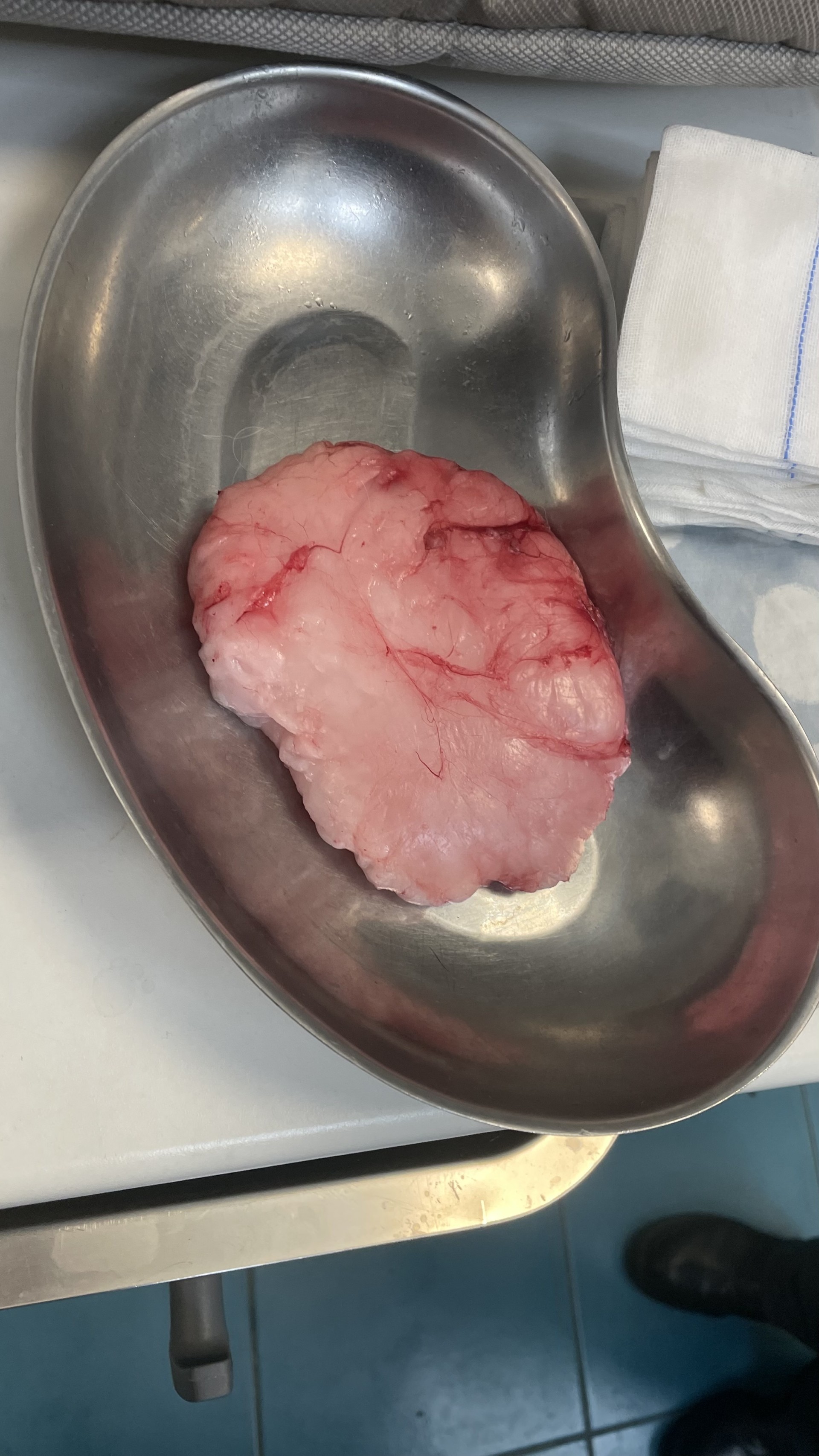 Tumor removed
